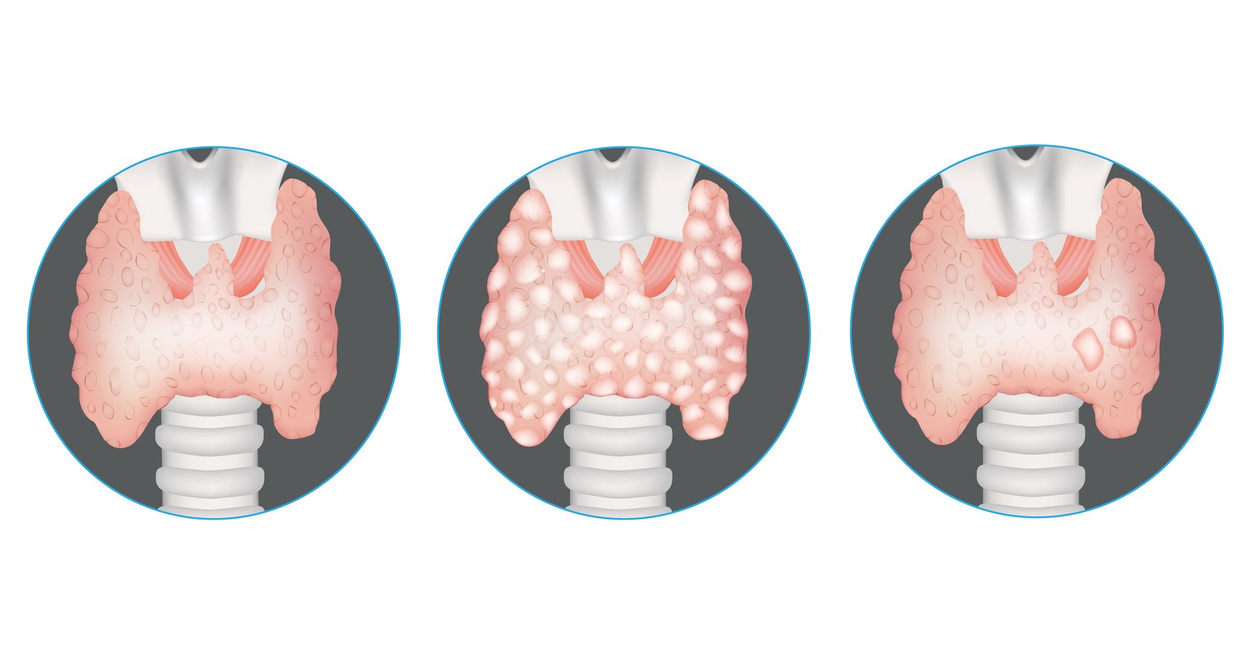 Thyroid Nodules Explained